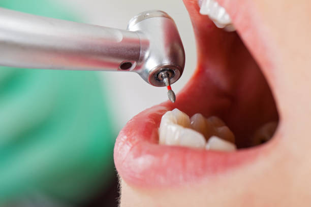 Best Emergency Broken Tooth Repair in Roswell, GA